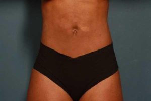 after liposuction female patient front view case 692