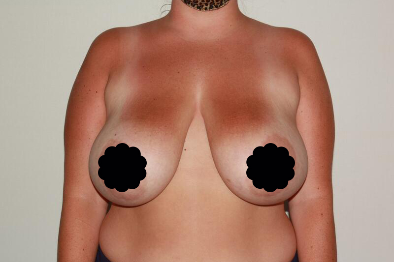 before breast reduction front view