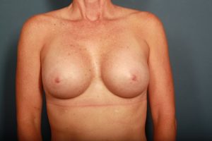 after breast augmentation front view female patient case 1420